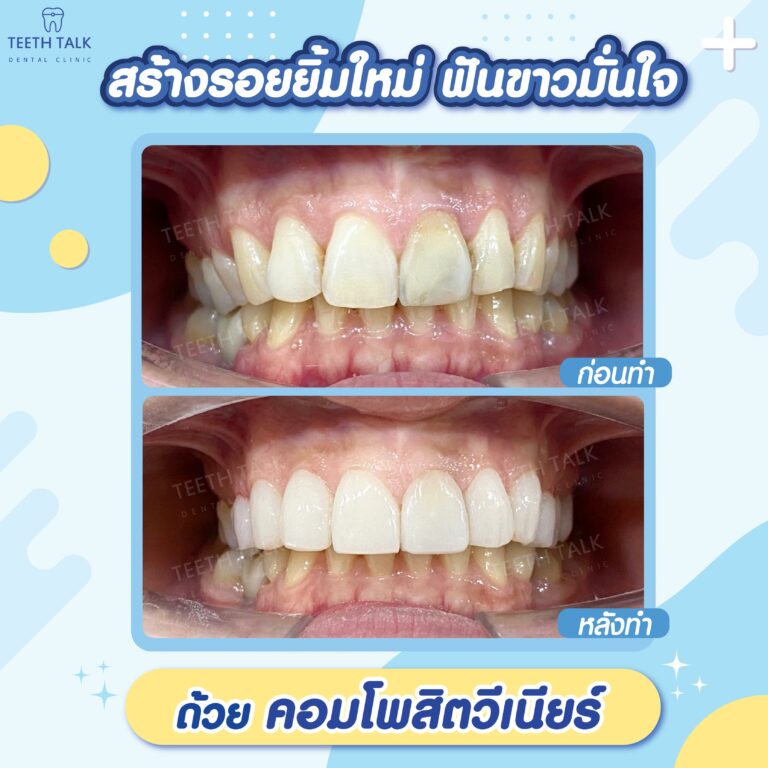 เช็คด่วน! โหงวเฮ้ง ลักษณะฟัน แบบไหนแย่ ต้องรีบแก้ก่อนสาย - Teeth Talk  Dental Clinic