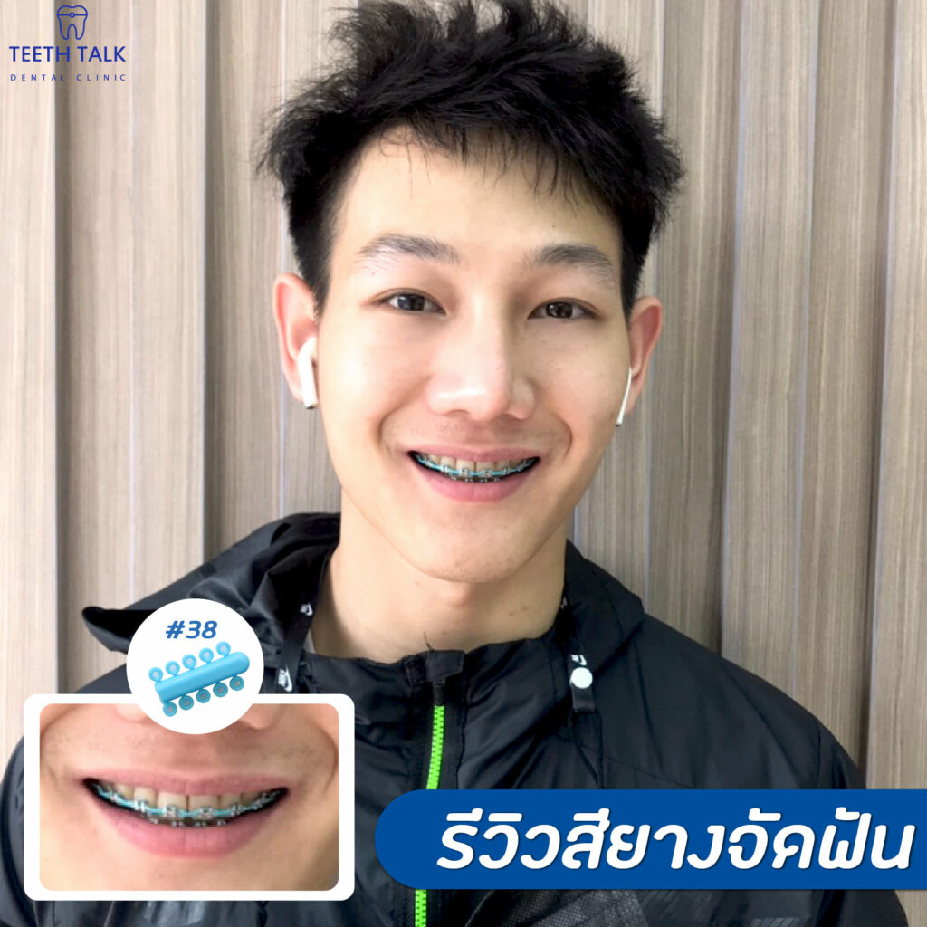 จัดฟันแบบใส Invisalign VS จัดฟันเหล็ก แบบไหนดีกว่ากัน