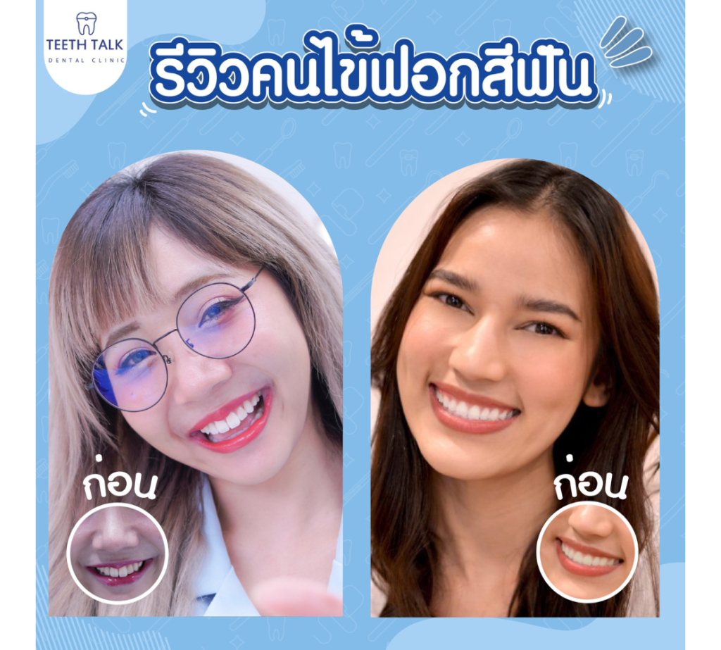 5 วิธีแก้ฟันเหลือง ให้ฟันขาวเร็วมีวิธีไหนบ้าง?