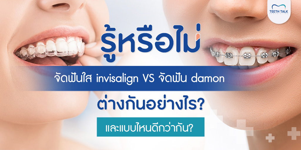 รู้หรือไม่ จัดฟันใส invisalign VS จัดฟัน damon ต่างกันอย่างไร? และแบบไหนดีกว่ากัน?