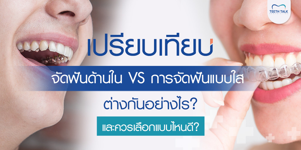 เปรียบเทียบ จัดฟันด้านใน VS การจัดฟันแบบใส ต่างกันอย่างไร? และควรเลือกแบบไหนดี?