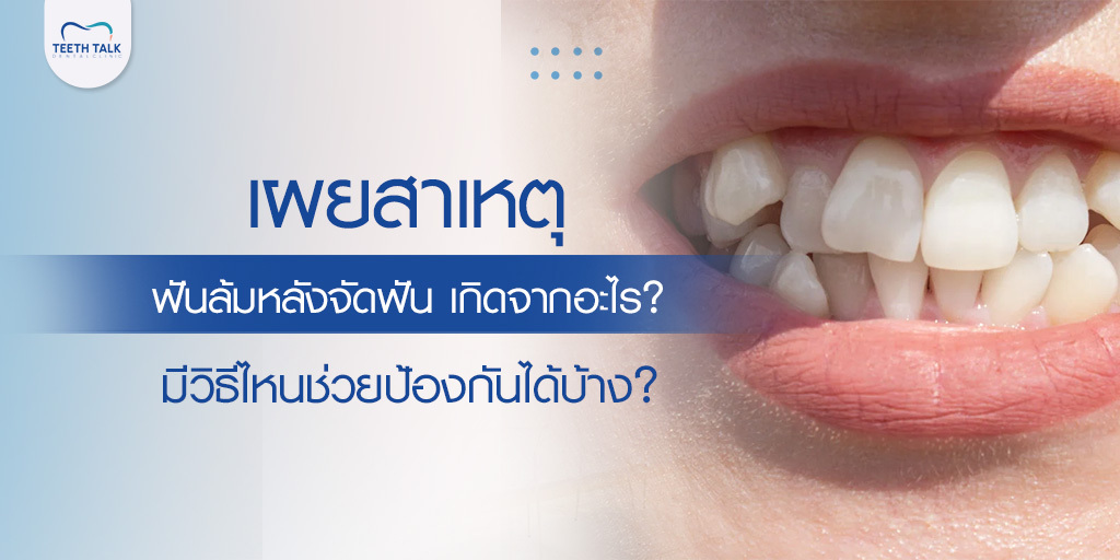 เผยสาเหตุ ฟันล้มหลังจัดฟัน เกิดจากอะไร? มีวิธีไหนช่วยป้องกันได้บ้าง?