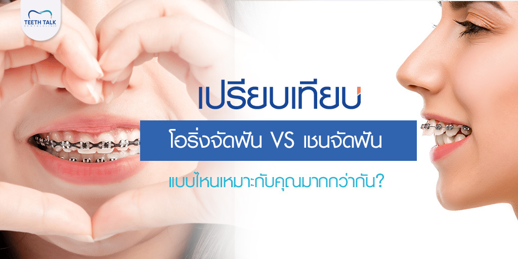 เปรียบเทียบ โอริ่งจัดฟัน VS เชนจัดฟัน แบบไหนเหมาะกับคุณมากกว่ากัน?